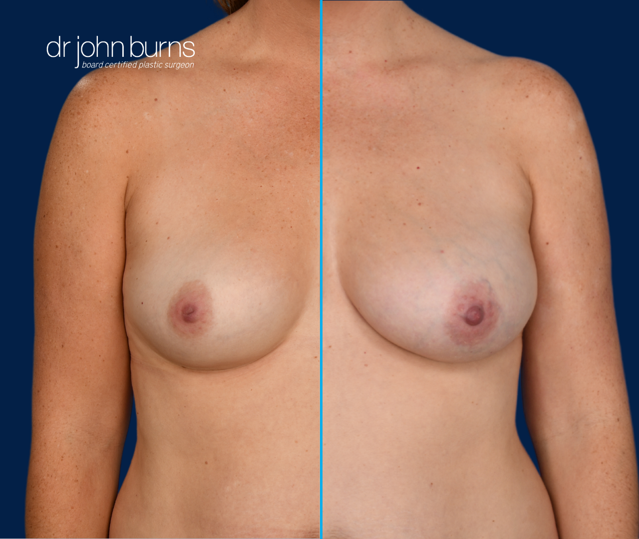 case 10- split screen before & after fat transfer to breast by top plastic surgeon, Dr. John Burns