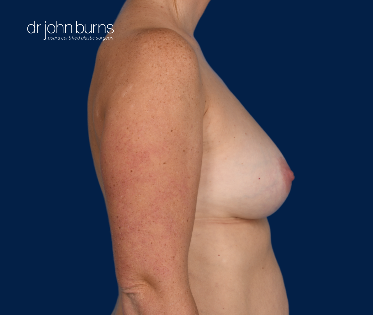 case 10- profile view | after fat transfer to breast by top plastic surgeon, Dr. John Burns