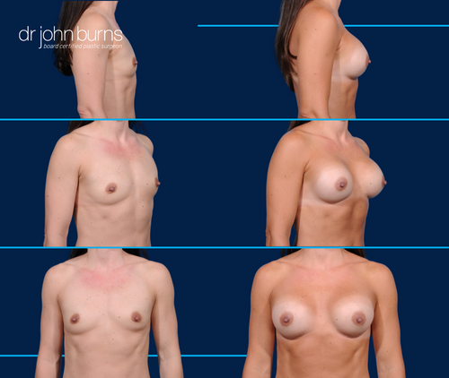 Before & After Breast Implants- Dallas Plastic Surgeon- Dr. John Burns