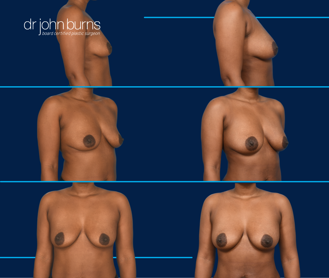 case 11- before and after breast augmentation fat transfer by top plastic surgeon, Dr. John Burns