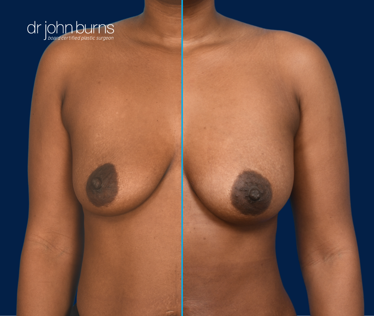 case 11- split screen before & after fat transfer to breast by top plastic surgeon, Dr. John Burns