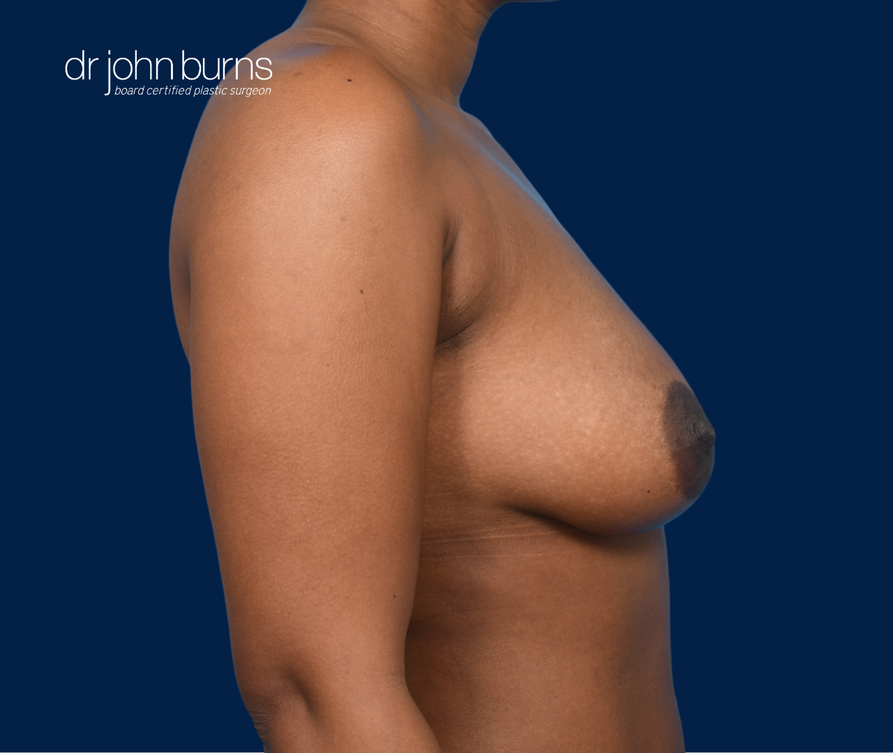 case 11- profile view | after fat transfer to breast by top plastic surgeon, Dr. John Burns