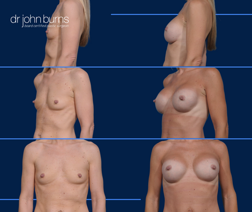 Before & After- Dallas Breast Augmentation- Dallas Plastic Surgeon- Dr. John Burns