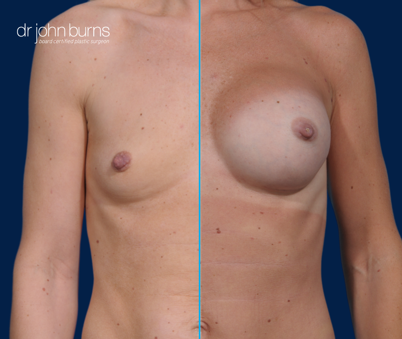 before and after breast implants- Dallas, Texas- Dr. John Burns