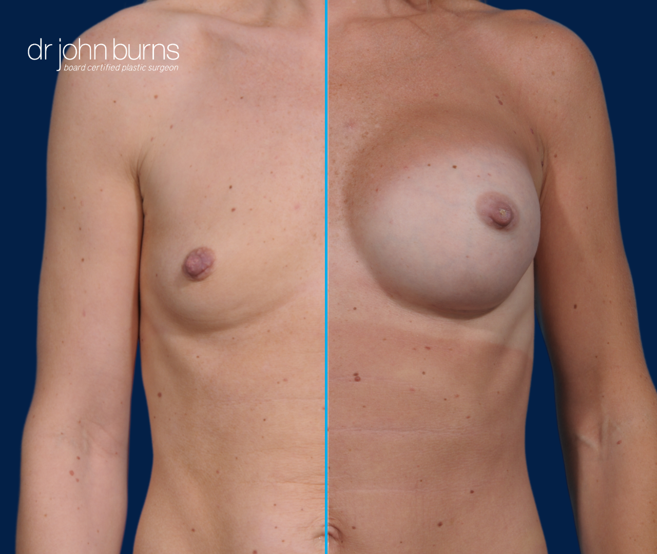 Breast Augmentation Results in Dallas, TX- Dr. John Burns.png__PID:a11c8403-93a4-49bf-9efa-aaf8c2ee1e29