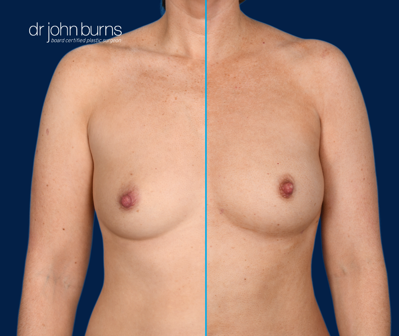 case 13- split screen before & after fat transfer to breast by top plastic surgeon, Dr. John Burns