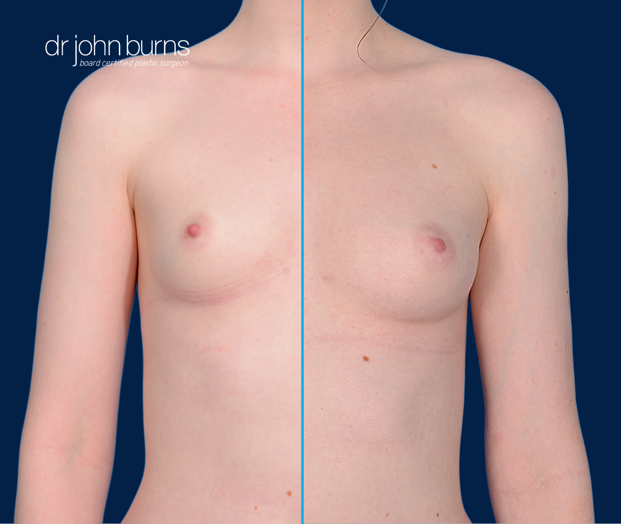 case 12- split screen before & after fat transfer to breast by top plastic surgeon, Dr. John Burns