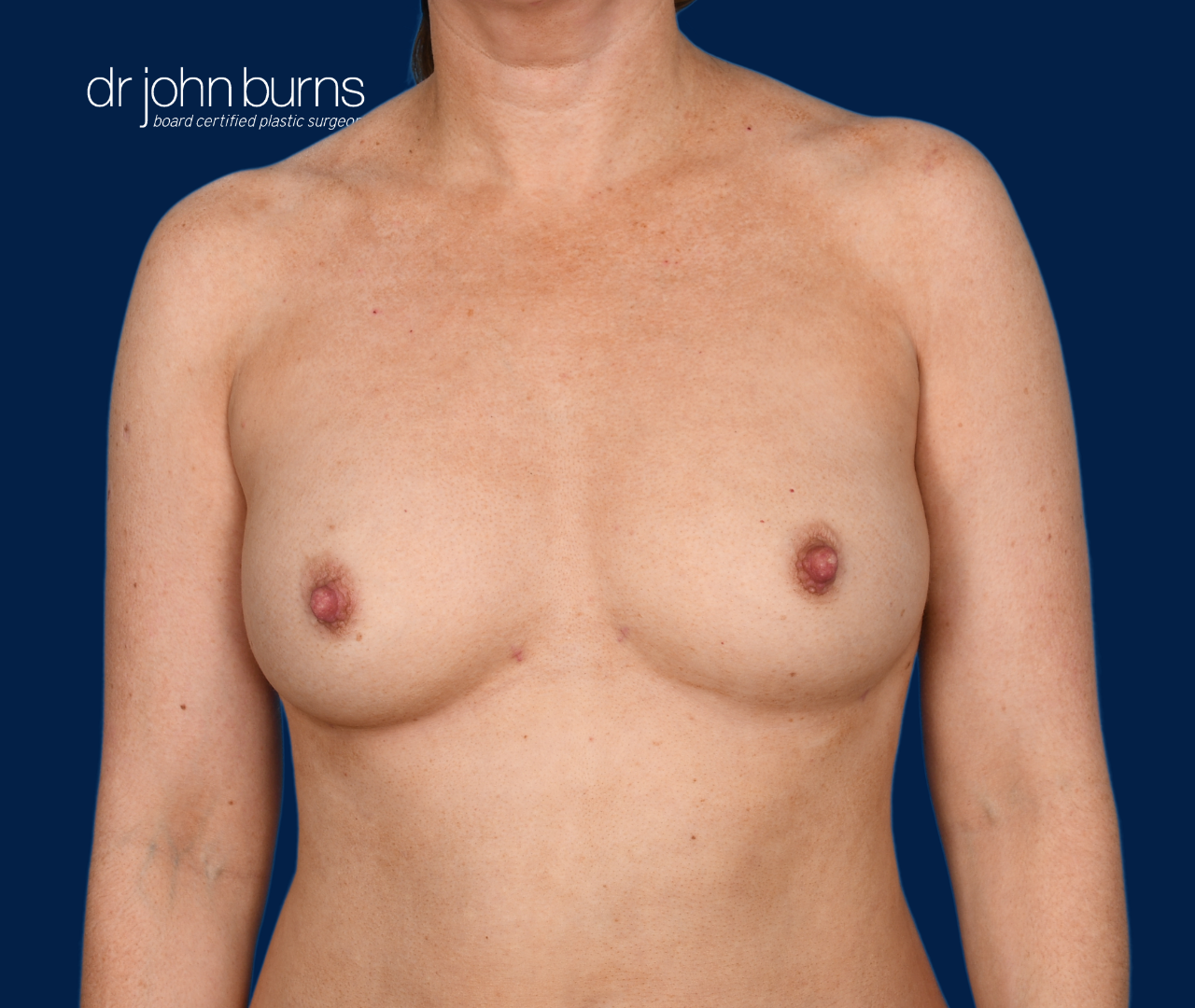 case 13- after fat transfer to breast by top plastic surgeon, Dr. John Burns