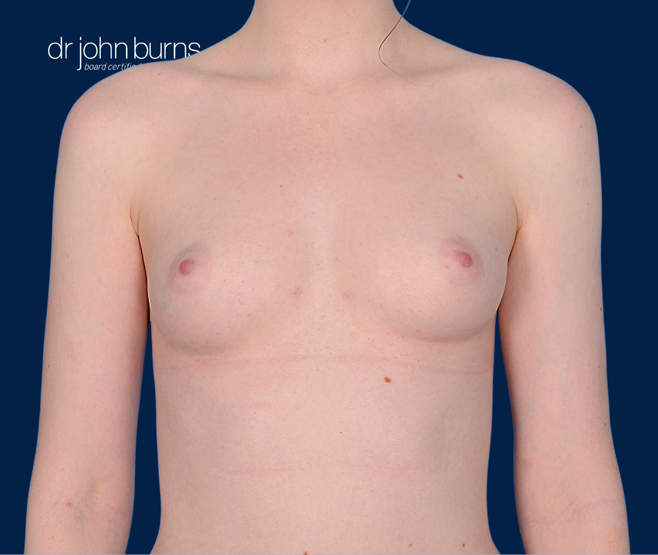 case 12- after fat transfer to breast by top plastic surgeon, Dr. John Burns