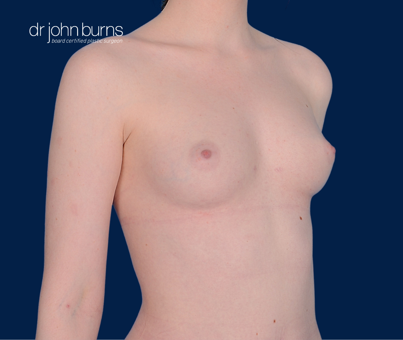 case 12- 45 degree view | after fat transfer to breast by top plastic surgeon, Dr. John Burns