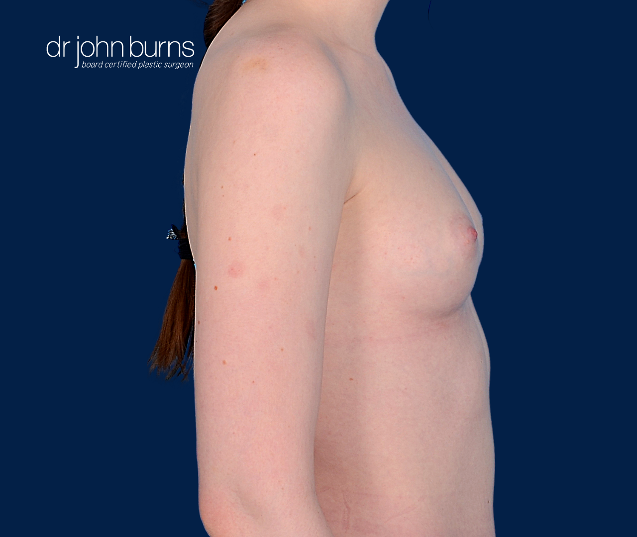 case 12- profile view | after fat transfer to breast by top plastic surgeon, Dr. John Burns