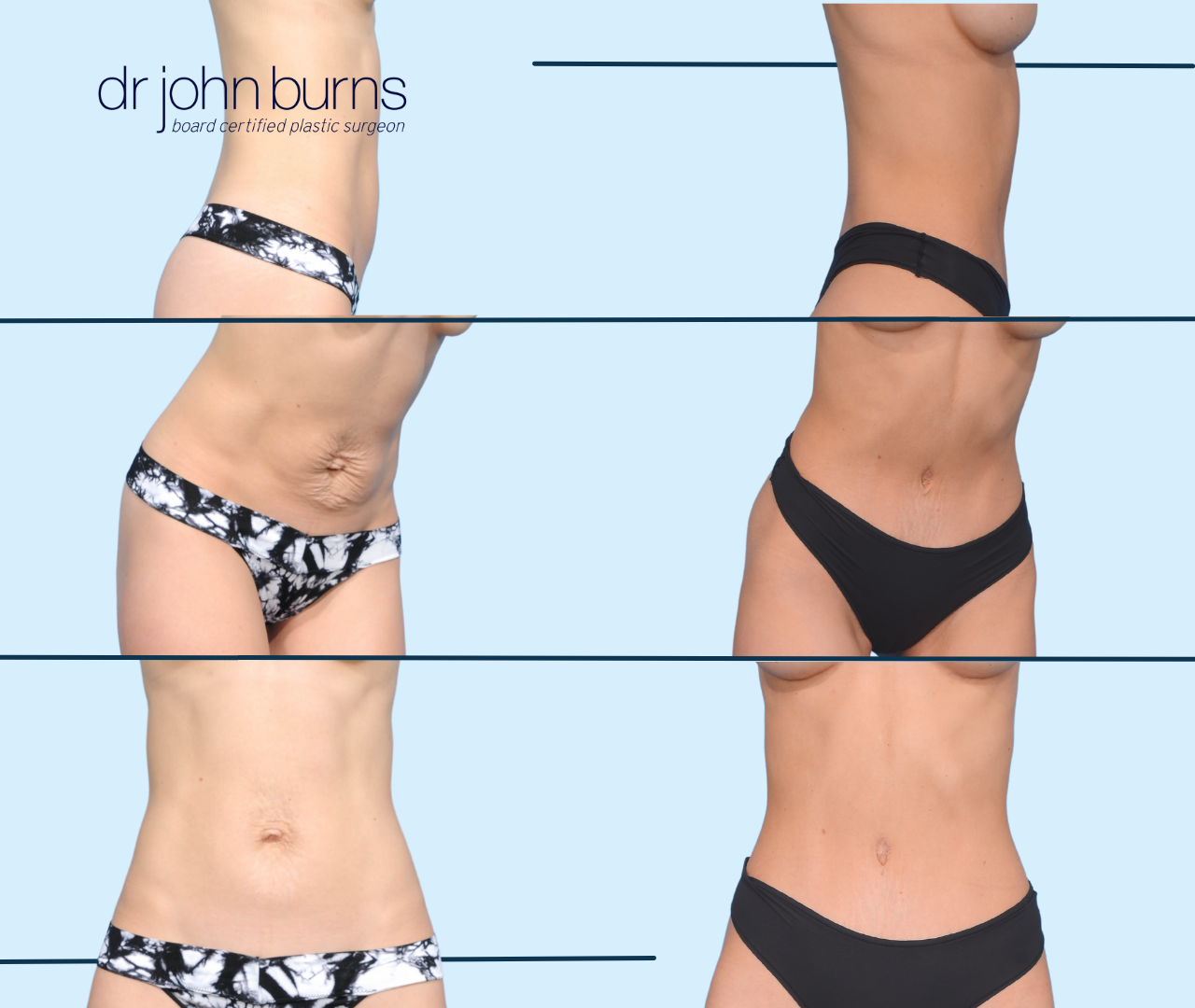 Case 12- Before & After Tiny Tummy Tuck with Lipo 360 by Dr. John Burns