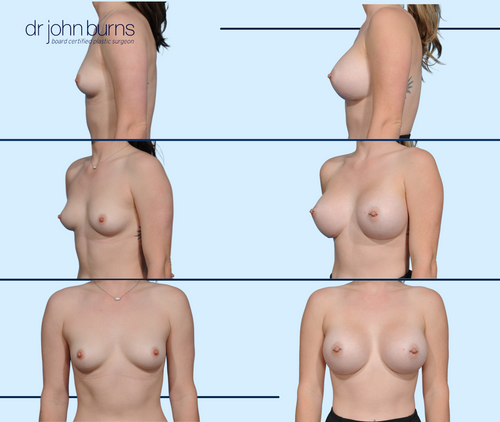 Before & After Breast Augmentation- Silicone Gel Implants- Dallas Plastic Surgeon- Dr. John Burns