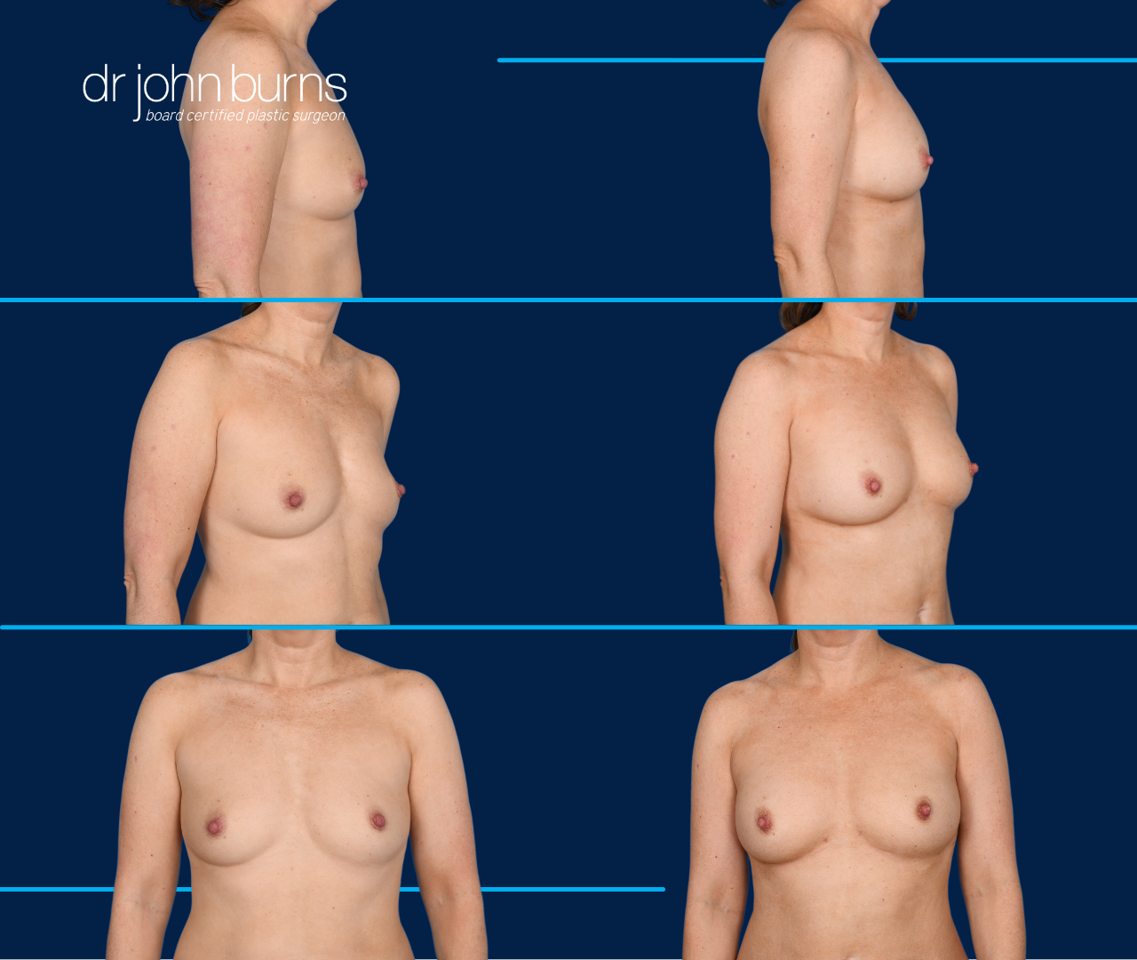 case 13- before and after breast augmentation fat transfer by top plastic surgeon, Dr. John Burns