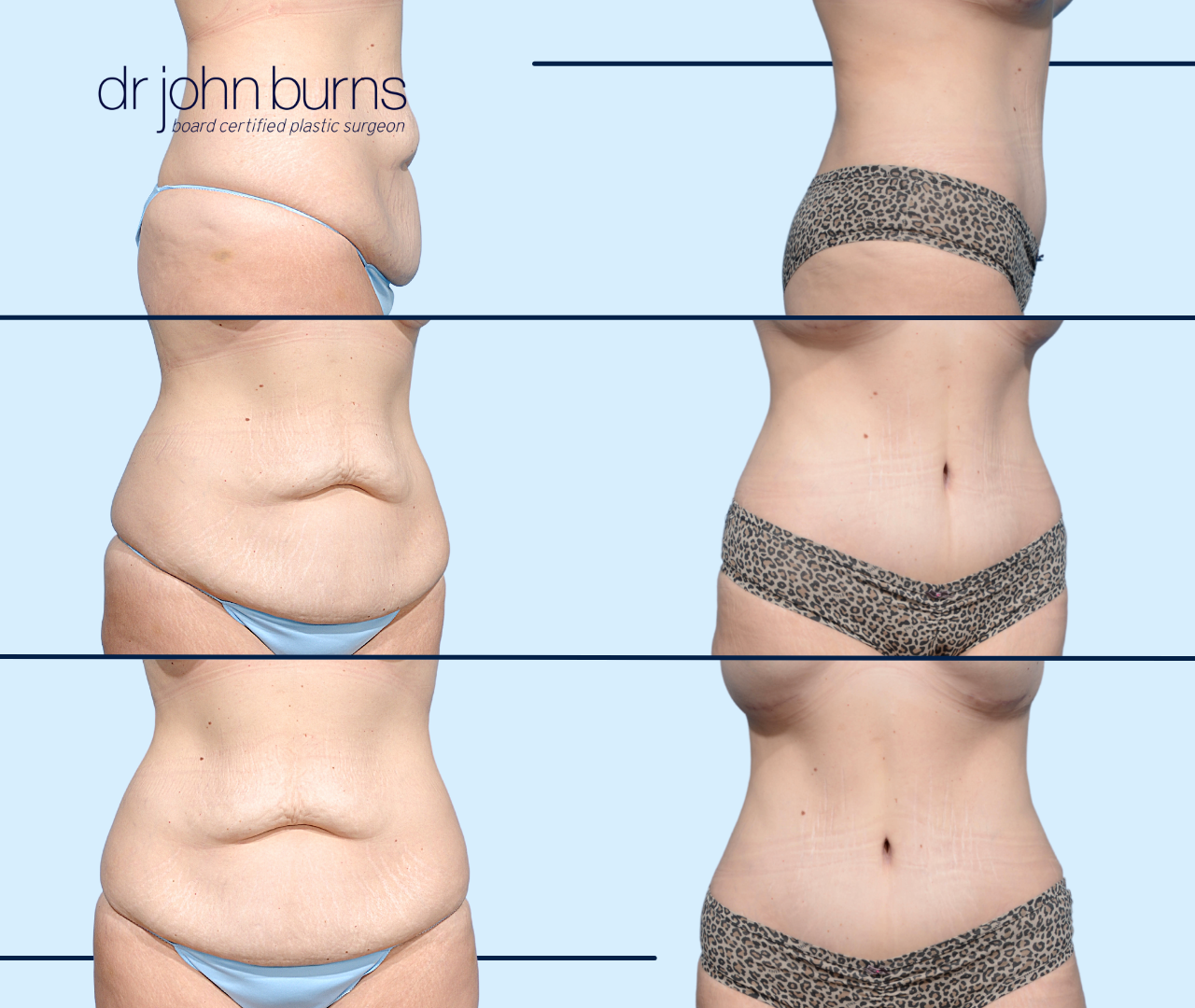 Case 13- Before & After Extended Tummy Tuck with Liposuction by Dr. John Burns