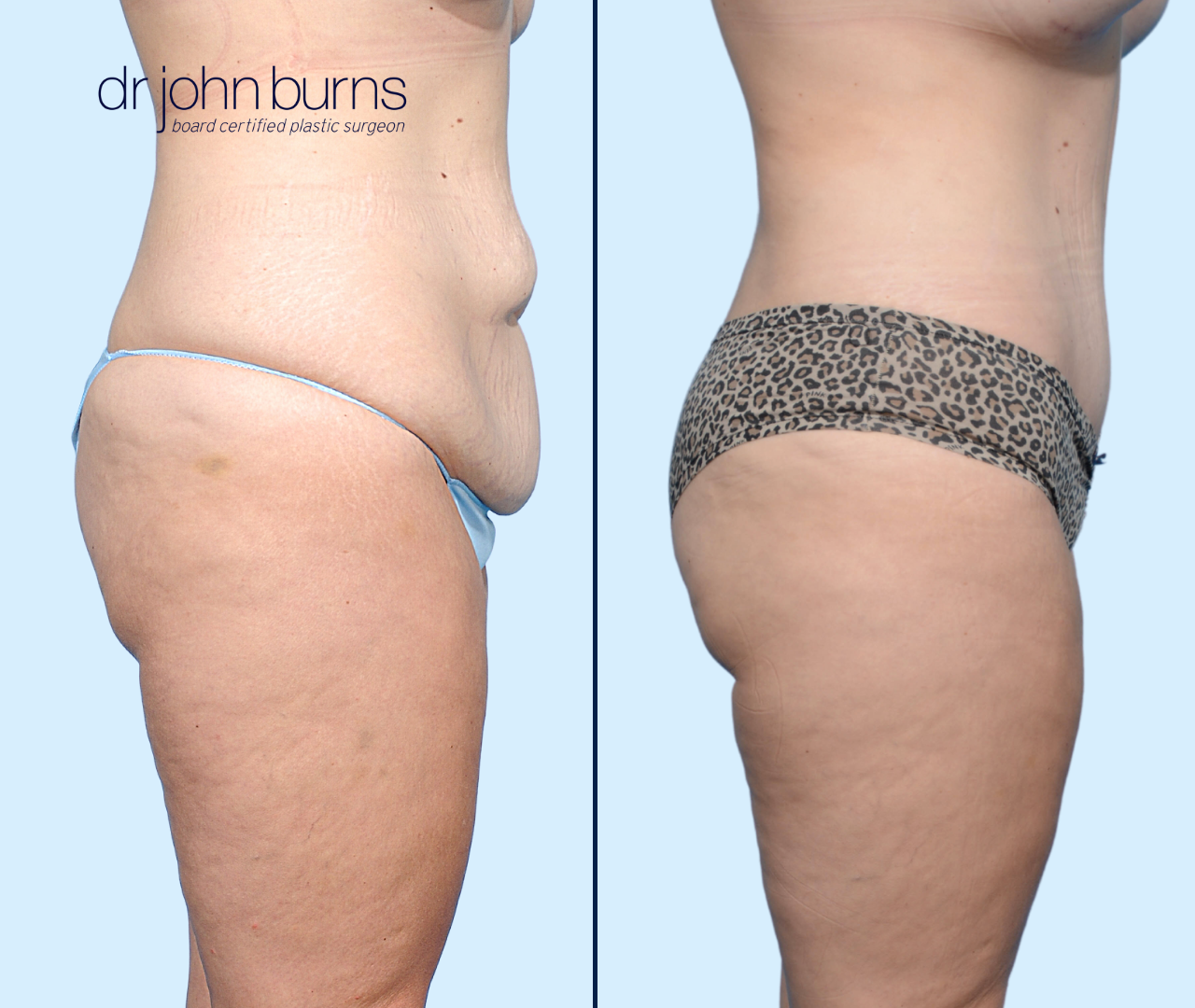 Case 13- Profile View- Before & After Extended Tummy Tuck with Liposuction by Dr. John Burns