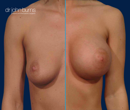 Before & After Breast Implants- Dallas Breast Augmentation- Dallas Plastic Surgeon Dr. John Burns