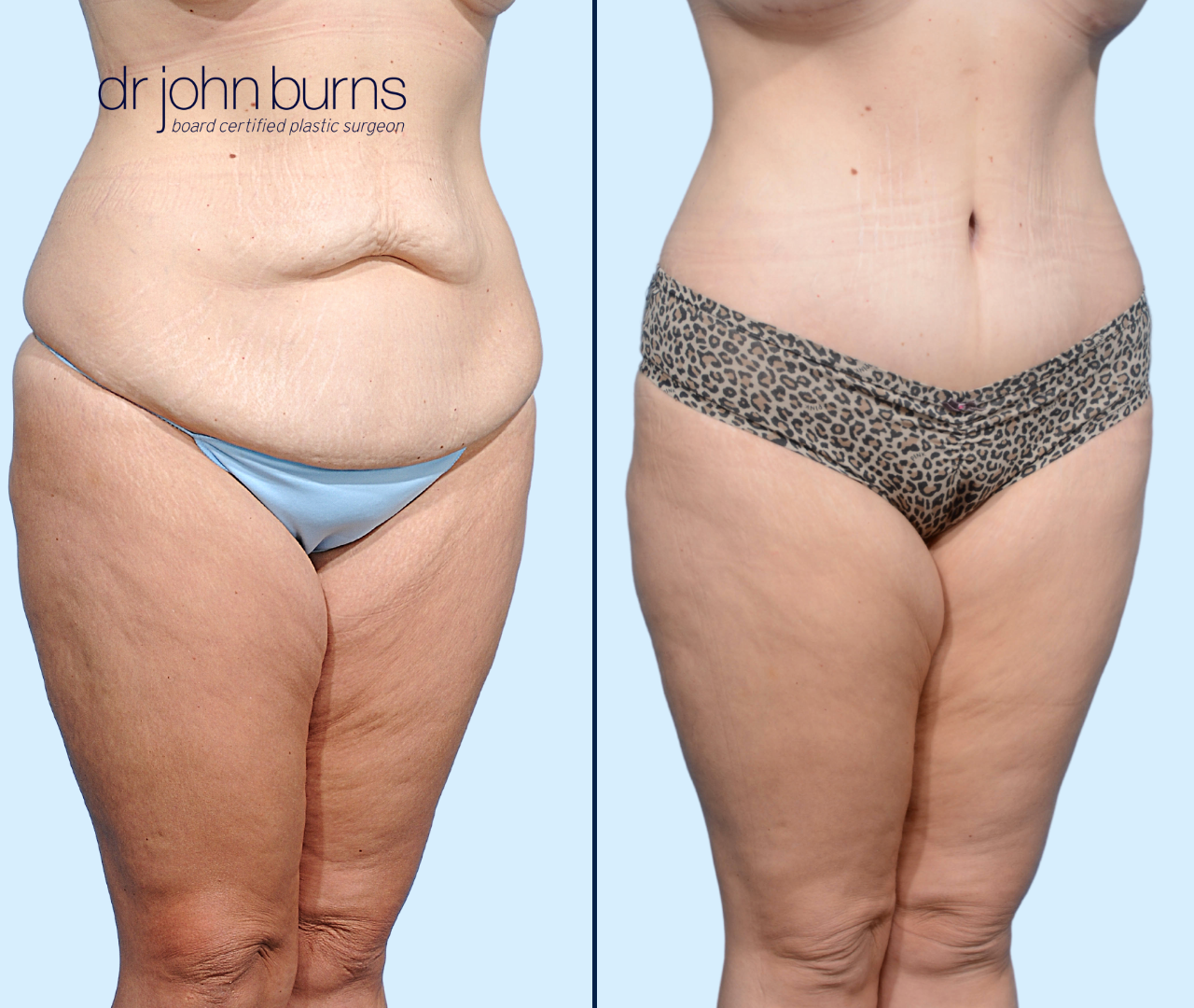 Case 13- 45 Degree View- Before & After Extended Tummy Tuck with Liposuction by Dr. John Burns