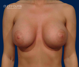 Before & After Breast Implants- Dallas Breast Augmentation- Dallas Plastic Surgeon Dr. John Burns