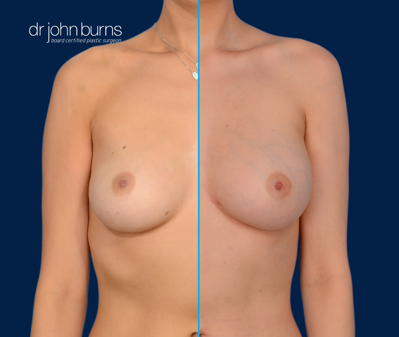 case 14- split screen before & after fat transfer to breast by top plastic surgeon, Dr. John Burns
