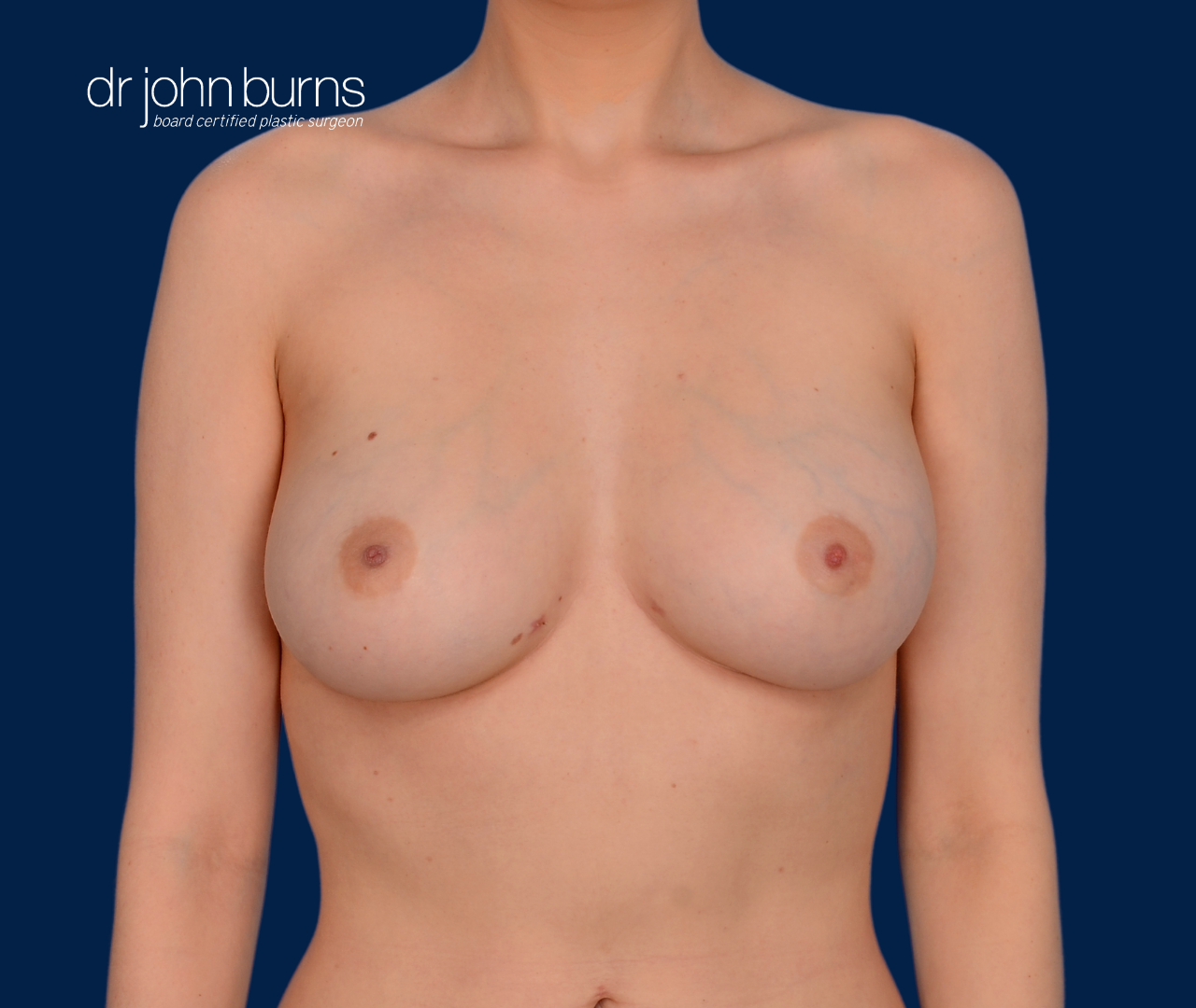 case 13- after fat transfer to breast by top plastic surgeon, Dr. John Burns