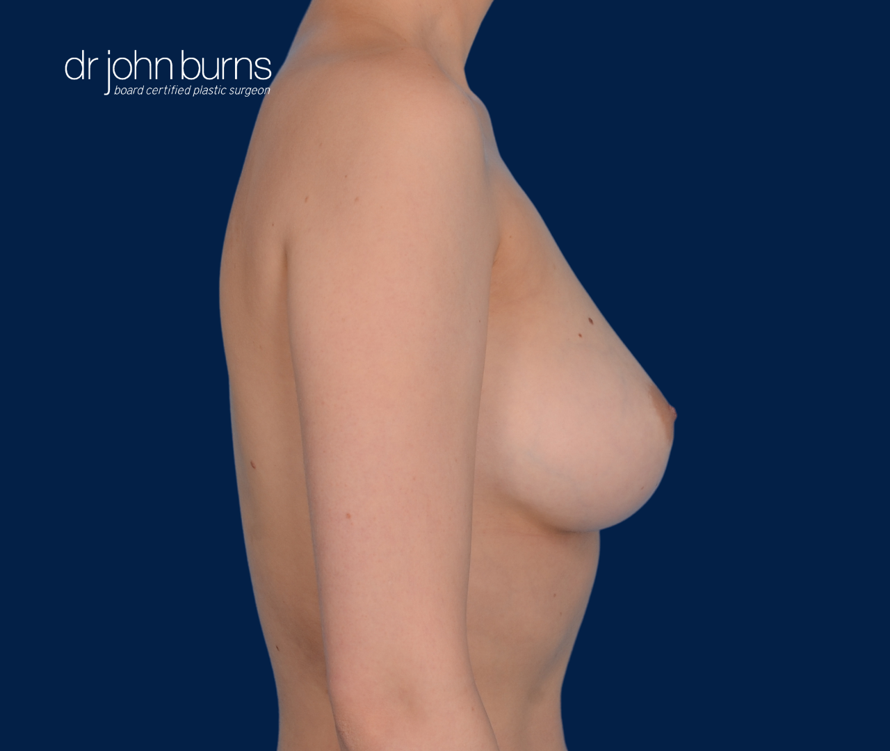 case 14- profile view | after fat transfer to breast by top plastic surgeon, Dr. John Burns