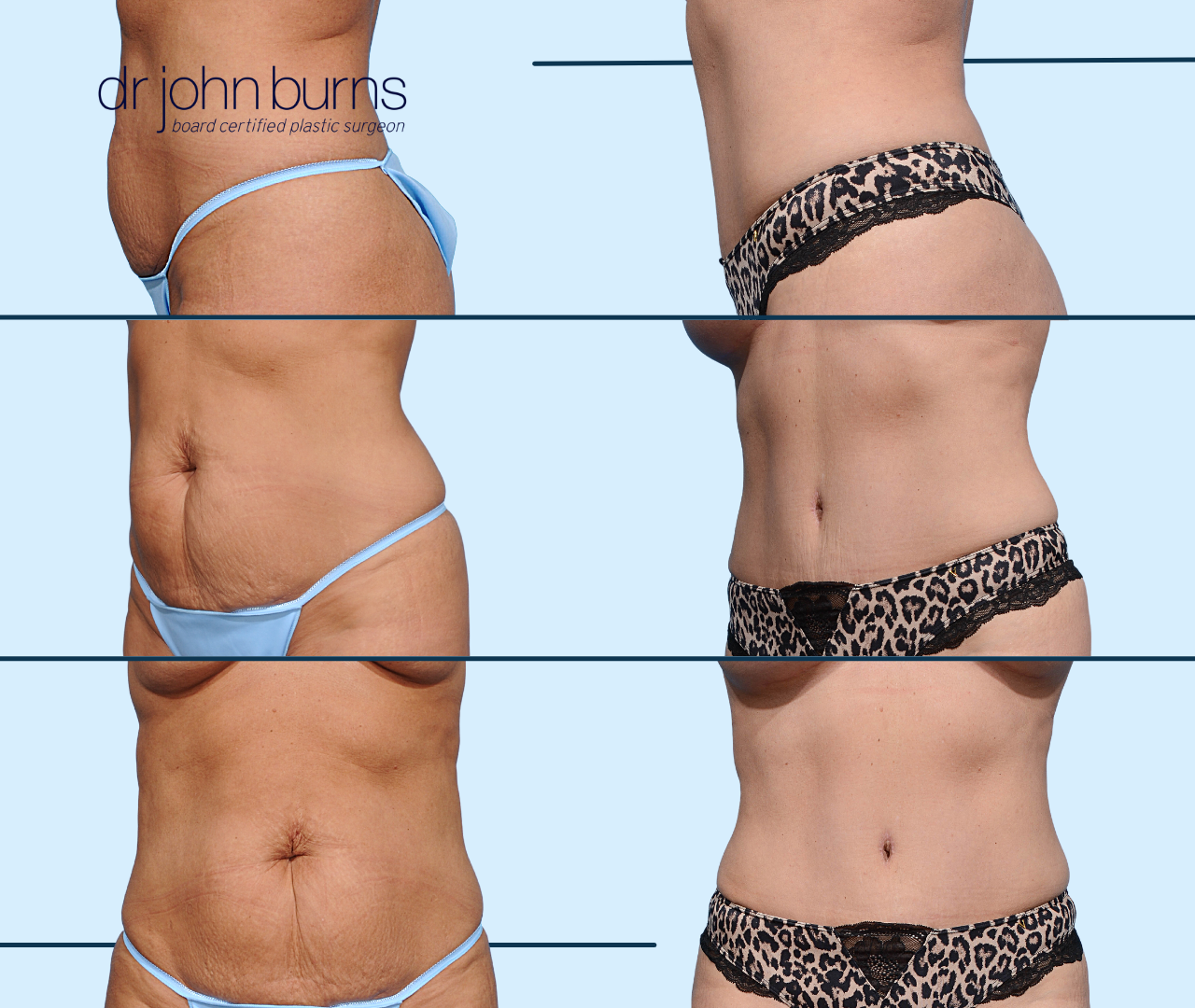 Case 14- Before & After Dallas Tummy Tuck by Dr. John Burns