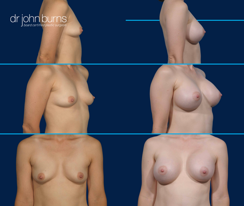 Before & After Breast Implants- Dallas Breast Augmentation- Dallas Plastic Surgeon Dr. John Burns