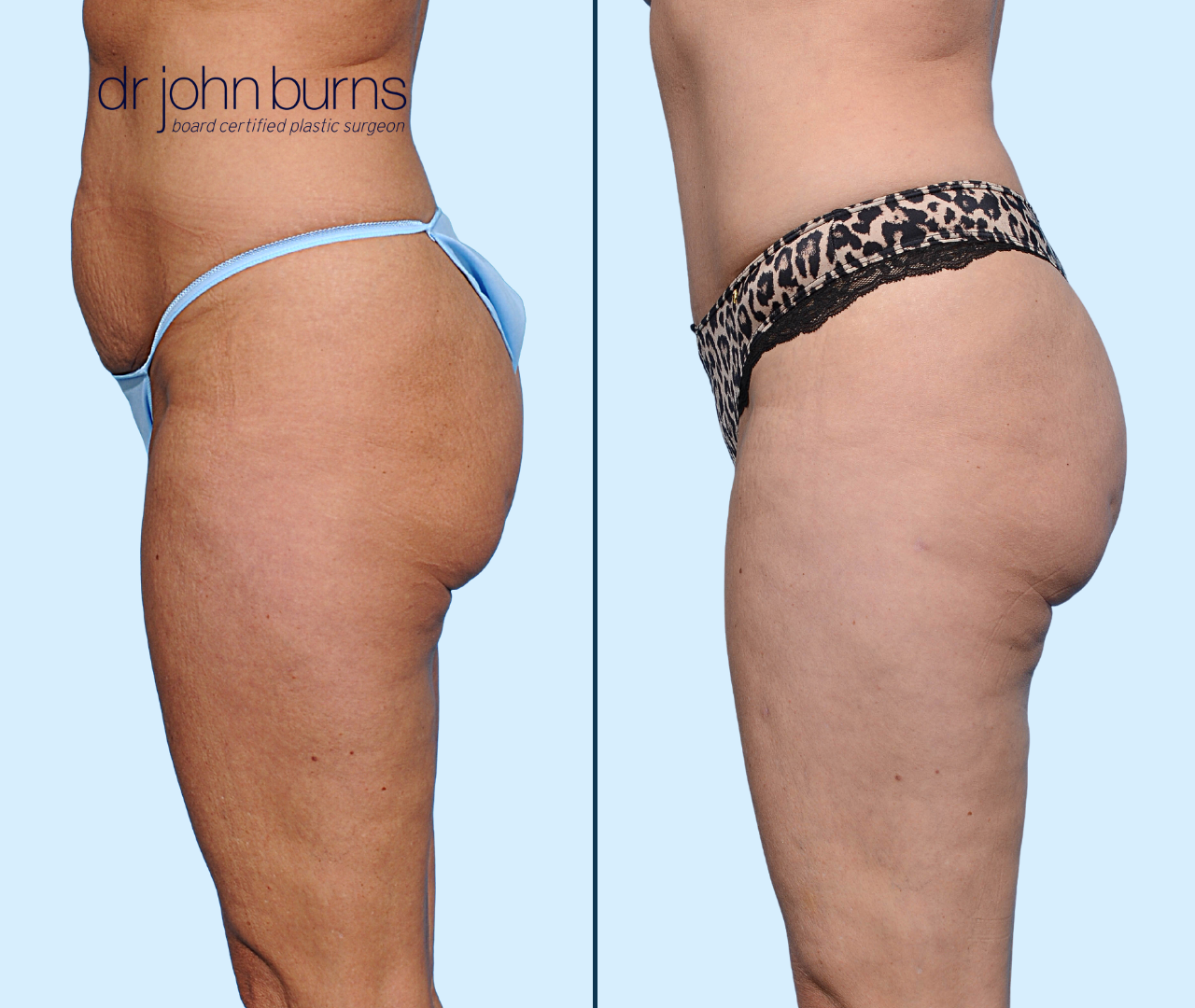 split screen before & after Dallas Tummy Tuck by Dr. John Burns