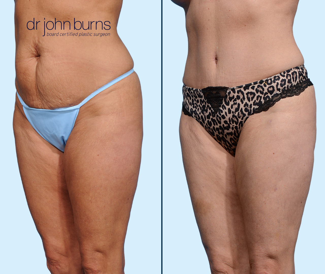 Case 14-45 Degree View- Before & After Dallas Tummy Tuck by Dr. John Burns