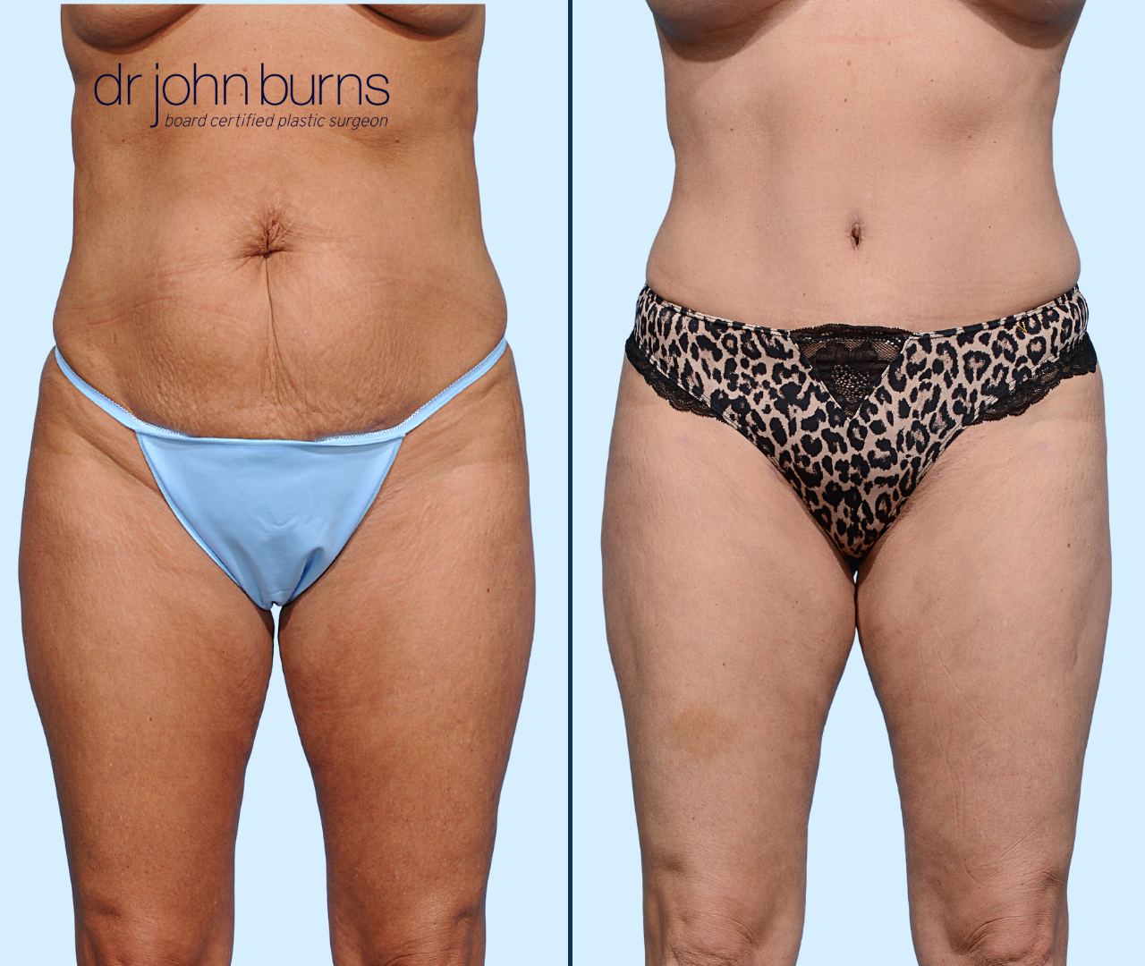 split screen | before & after Dallas Tummy Tuck by Dallas Mommy Makeover Surgeon, Dr. John Burns