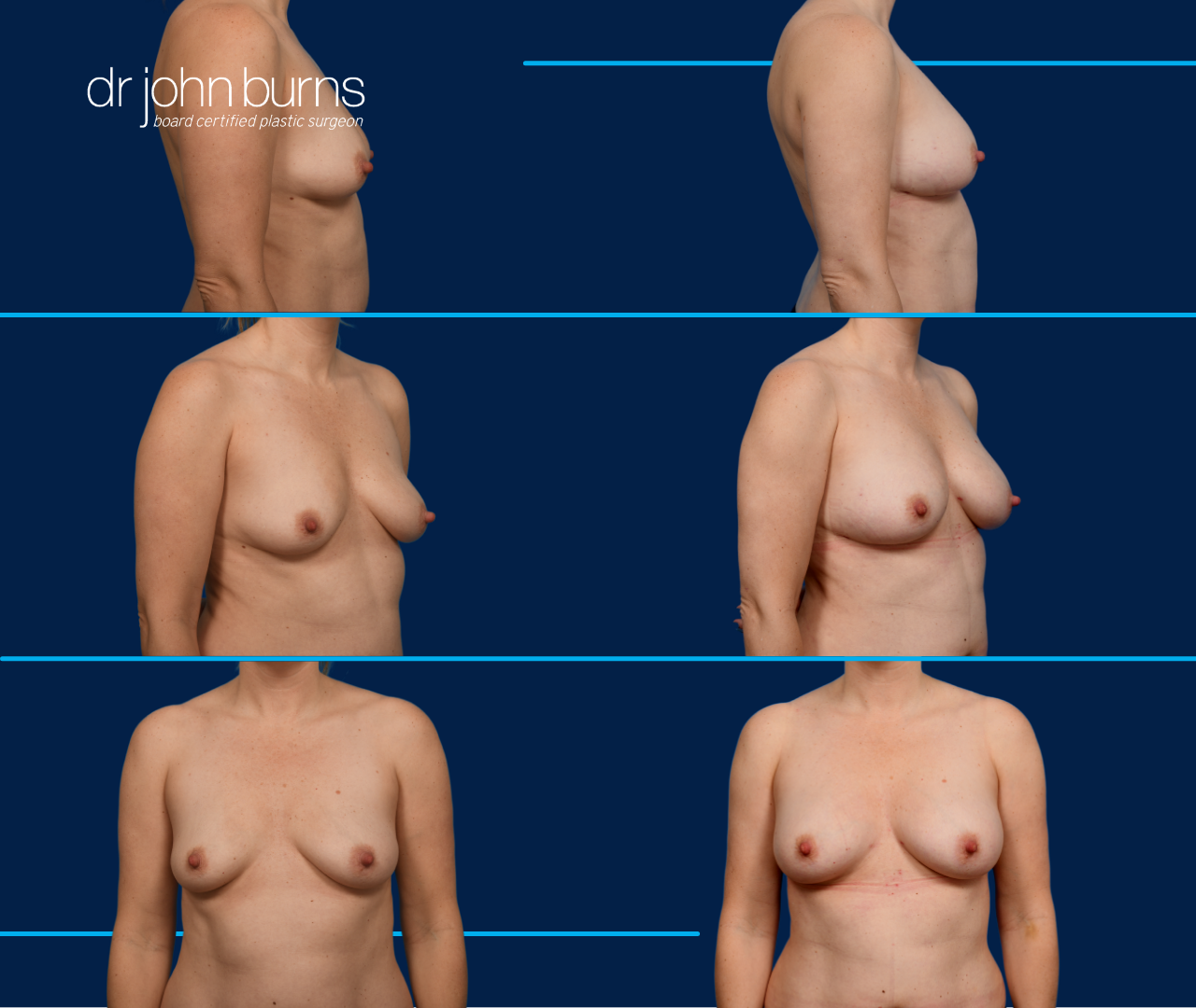 case 15- before and after breast augmentation fat transfer by top plastic surgeon, Dr. John Burns