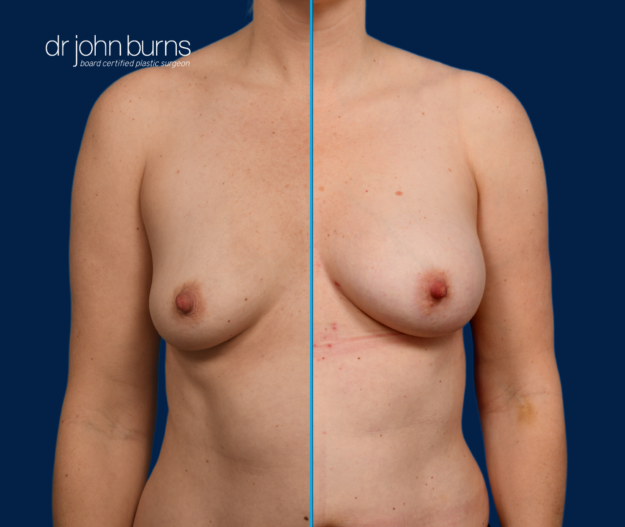 case 15- split screen before & after fat transfer to breast by top plastic surgeon, Dr. John Burns