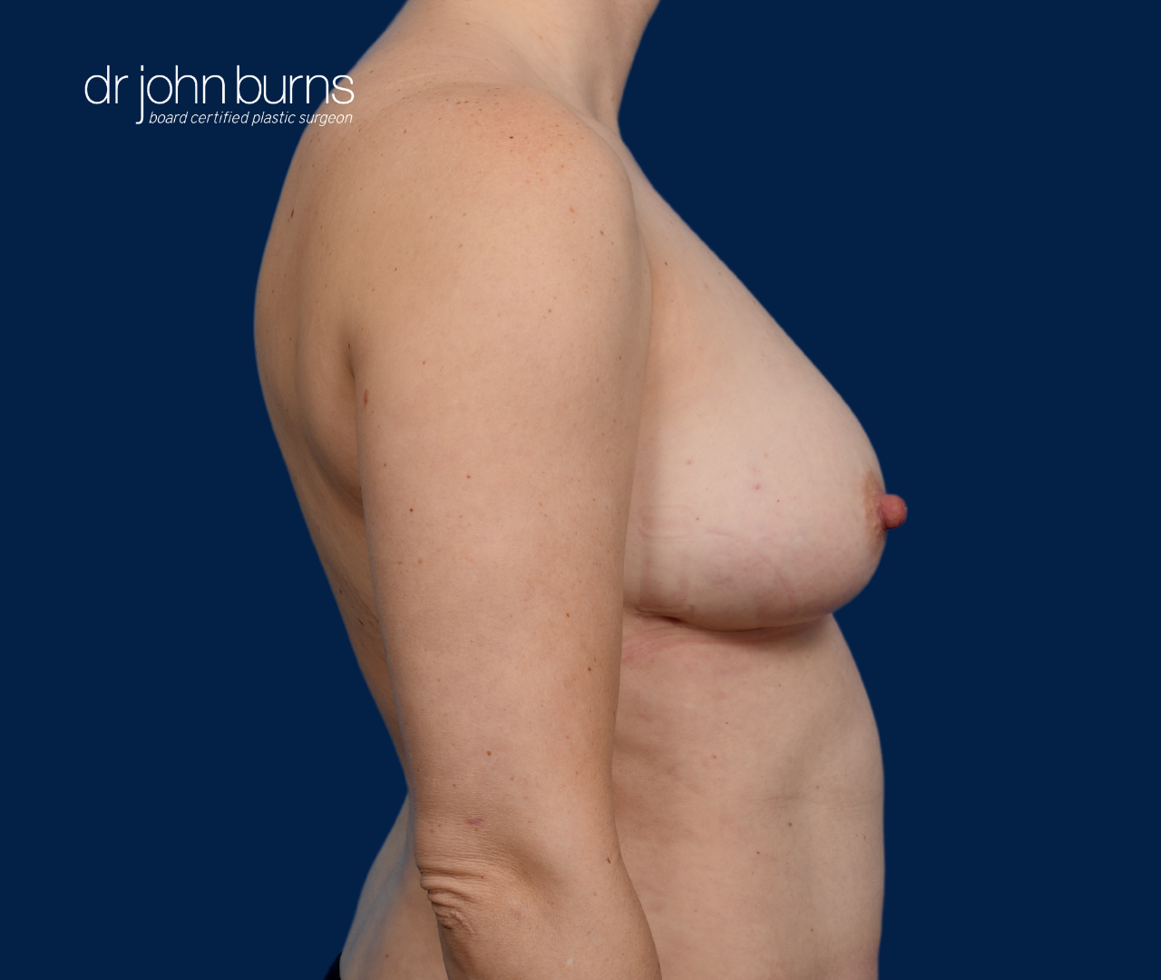 case 15- profile view | after fat transfer to breast by top plastic surgeon, Dr. John Burns