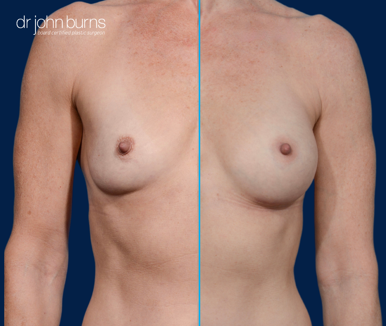 before and after breast implants- Dallas, Texas- Dr. John Burns