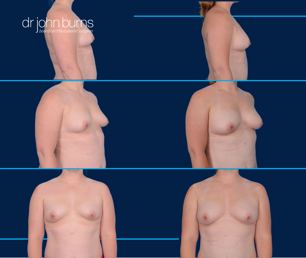 case 16- before and after breast augmentation fat transfer by top plastic surgeon, Dr. John Burns