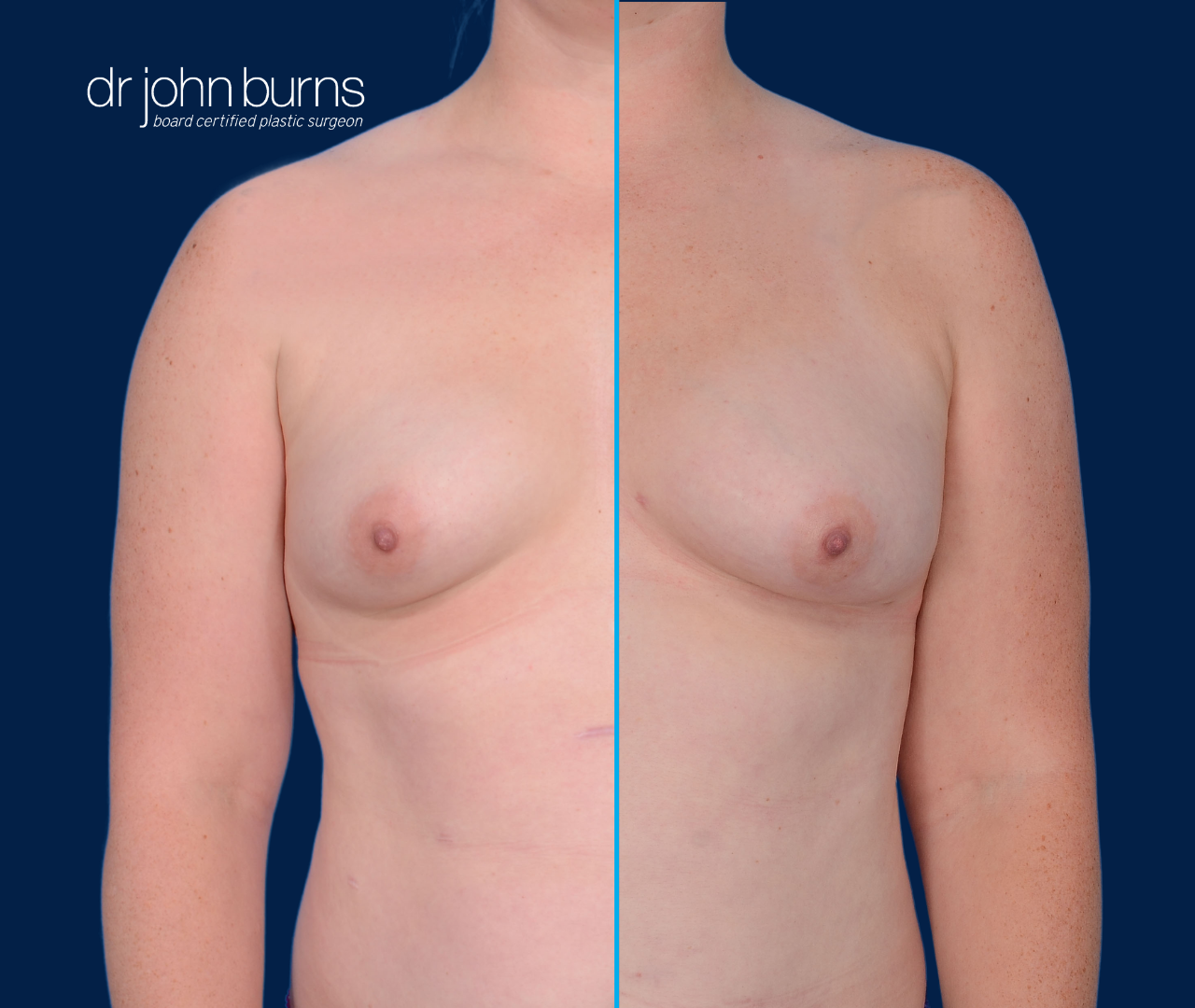 case 16- split screen before & after fat transfer to breast by top plastic surgeon, Dr. John Burns