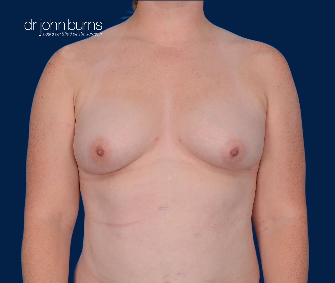 case 16- after fat transfer to breast by top plastic surgeon, Dr. John Burns