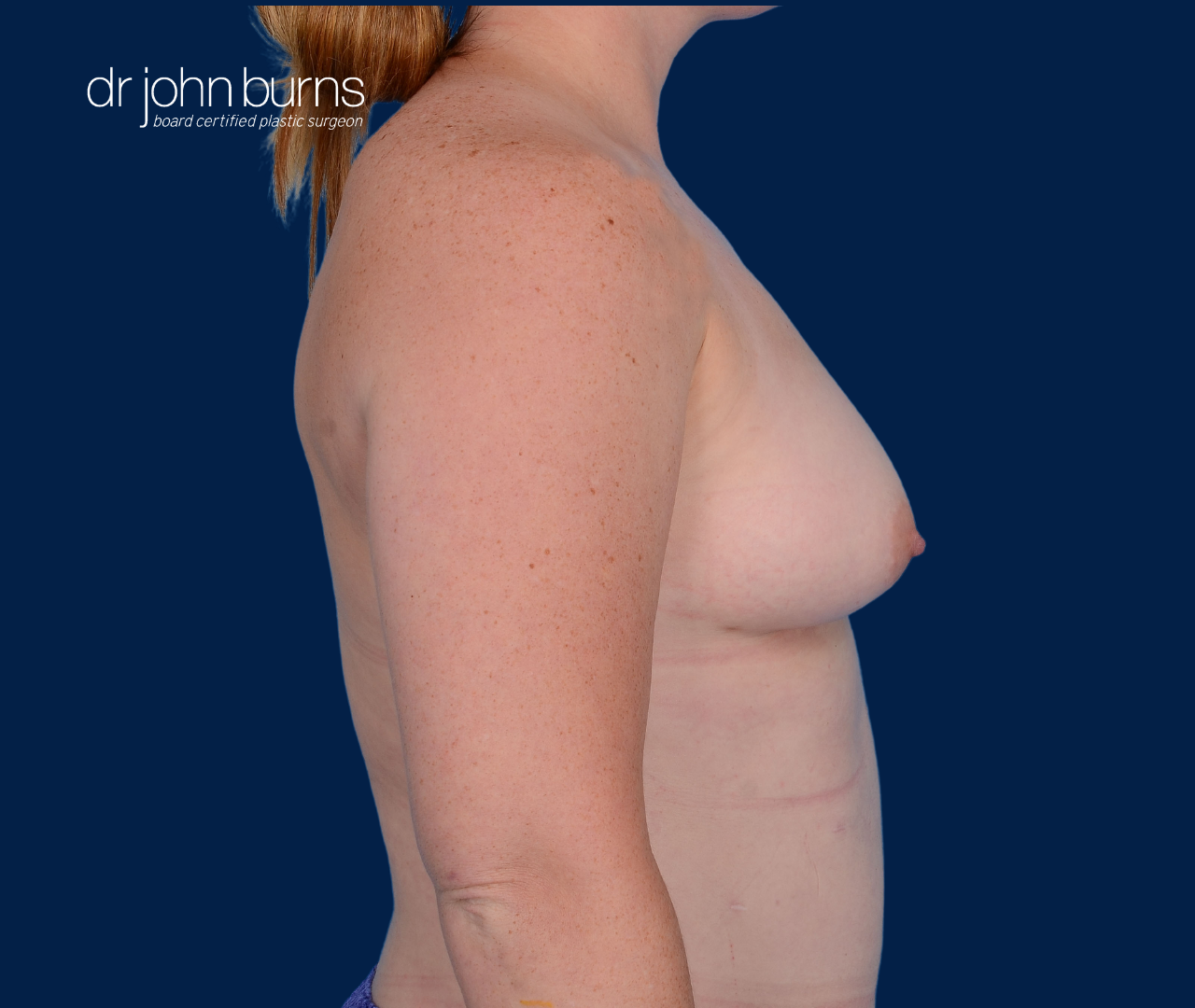 case 16- profile view | after fat transfer to breast by top plastic surgeon, Dr. John Burns