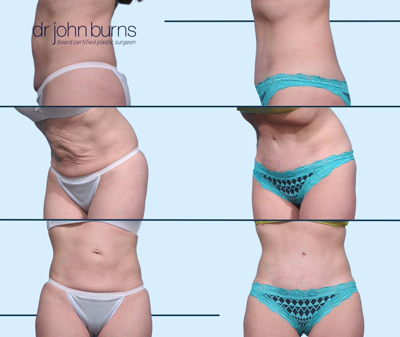 Case 16- Before & After Mini Tummy Tuck with Umbilical Float & Lipo 360 by Dr. John Burns