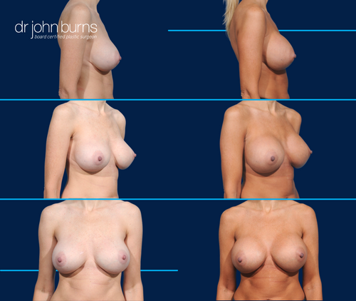 Before & After Breast Augmentation- Profile View-Silicone Gel Breast Implants- Dallas Plastic Surgeon Dr. John Burns