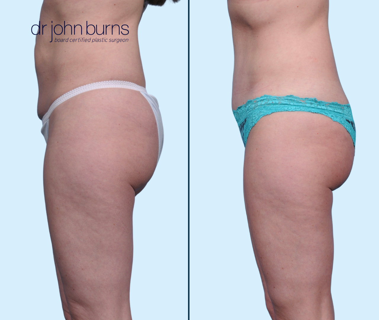 Case 16-Profile View-Before & After Mini Tummy Tuck with Umbilical Float & Lipo 360 by Dr. John Burns