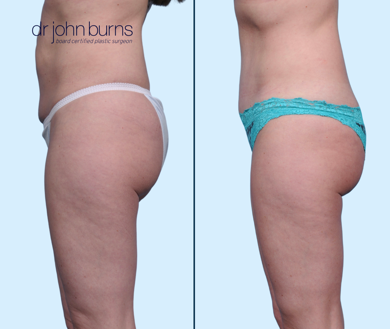 Dallas Tummy Tuck Before & After Results by Dr. John Burns – Dr