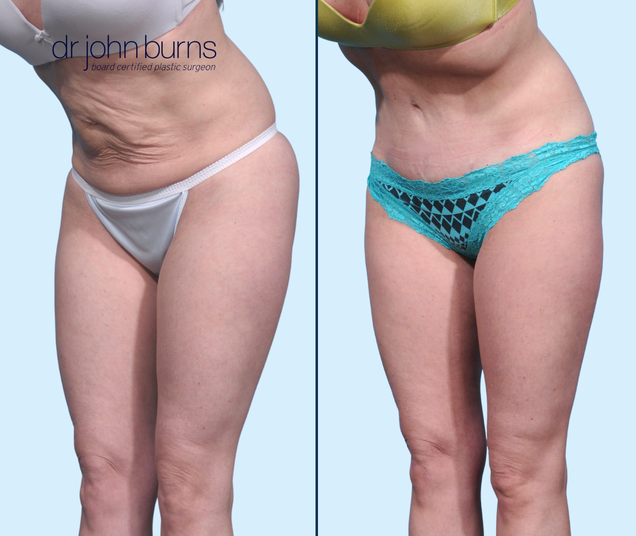 Case 16-45 Degree View-Before & After Mini Tummy Tuck with Umbilical Float & Lipo 360 by Dr. John Burns