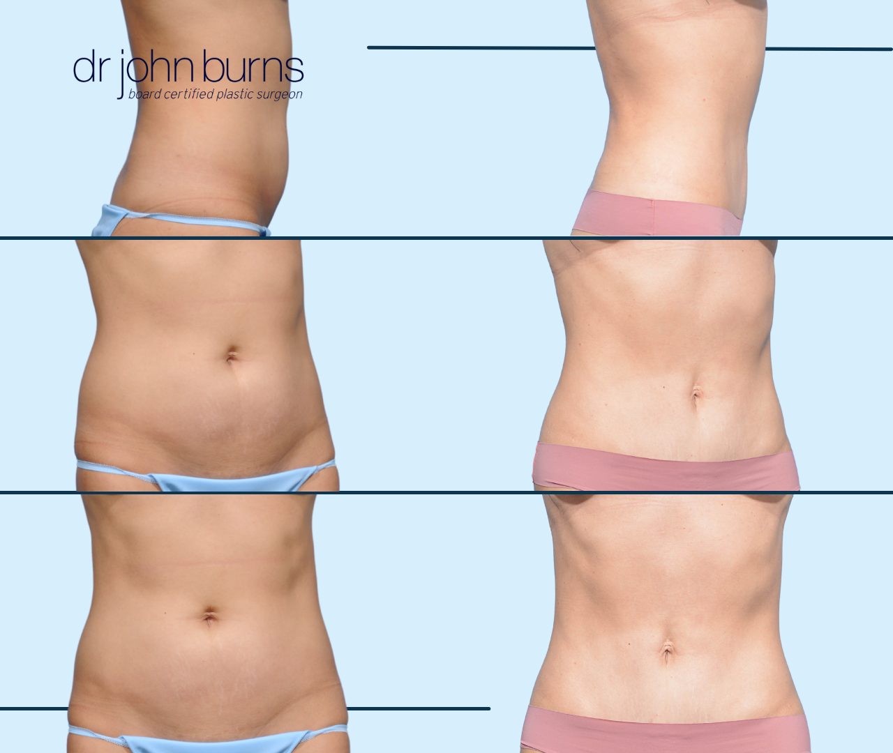 Before & After Mini Tummy Tuck with umbilical float by Dallas Tummy Tuck surgeon, Dr. John Burns