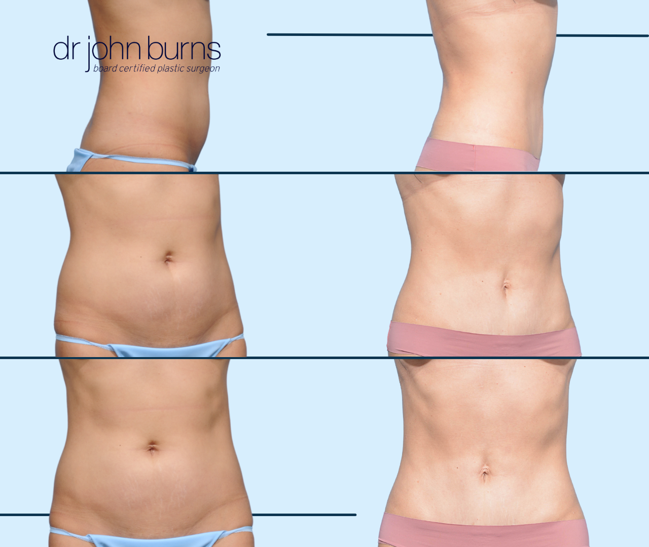 Dr. Parker Talks Tummy Tucks: Figuring Out a Treatment Plan for