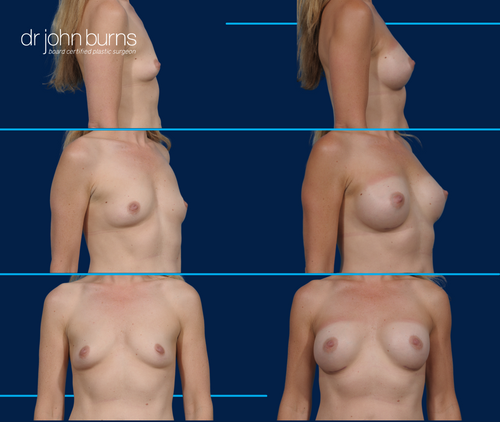 Before & After Breast Augmentation- Silicone Gel Breast Implants- Dallas Plastic Surgeon Dr. John Burns