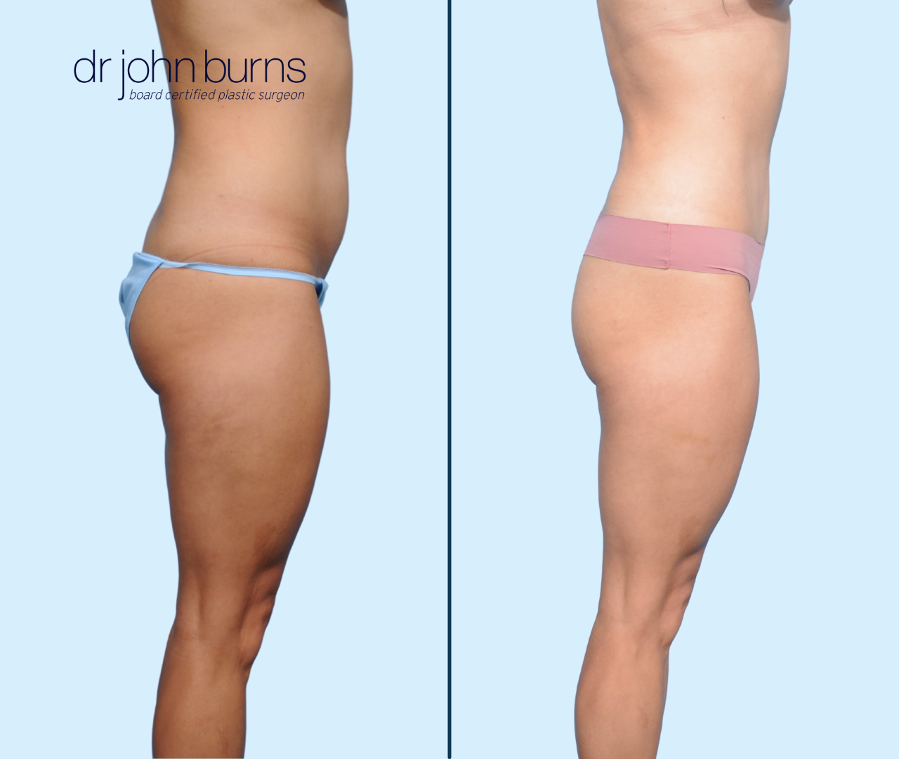 Before & After Mini Tummy Tuck with umbilical float by Dallas Tummy Tuck surgeon, Dr. John Burns