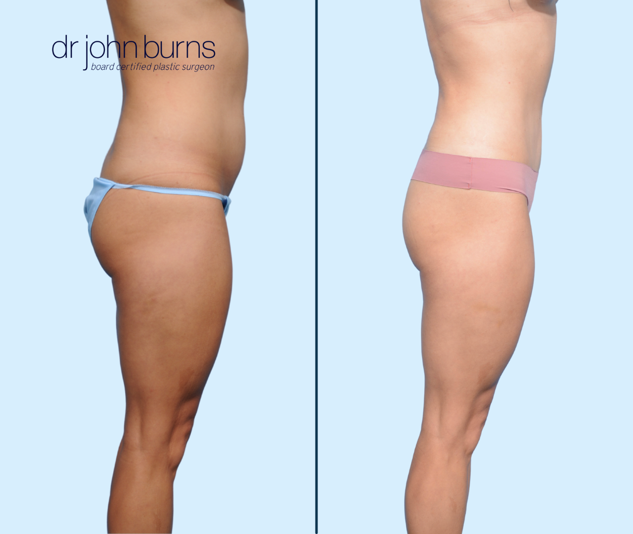 Mini Tummy Tuck by DFW Aesthetics and Cosmetic Surgery