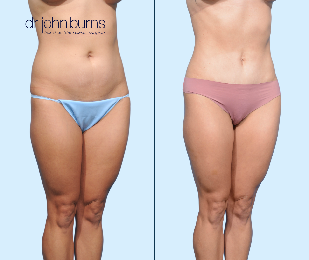 Case 17- 45 Degree View- Before and After Tiny Tummy Tuck with Umbilical Float and Ab Etching by Dr. John Burns